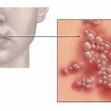 herpes - herpes simplex