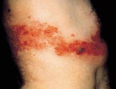 herpes - herpes varicella zoster